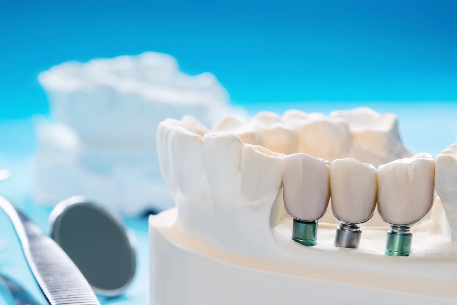 Modelo de yeso de una arcada dental con tres implantes y sus coronas, junto a un espejo dental