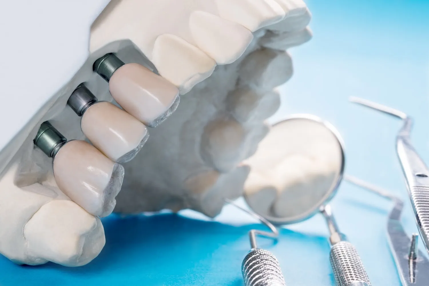 Modelo dental con implantes y pilares de cicatrización junto a un espejo y una sonda de exploración