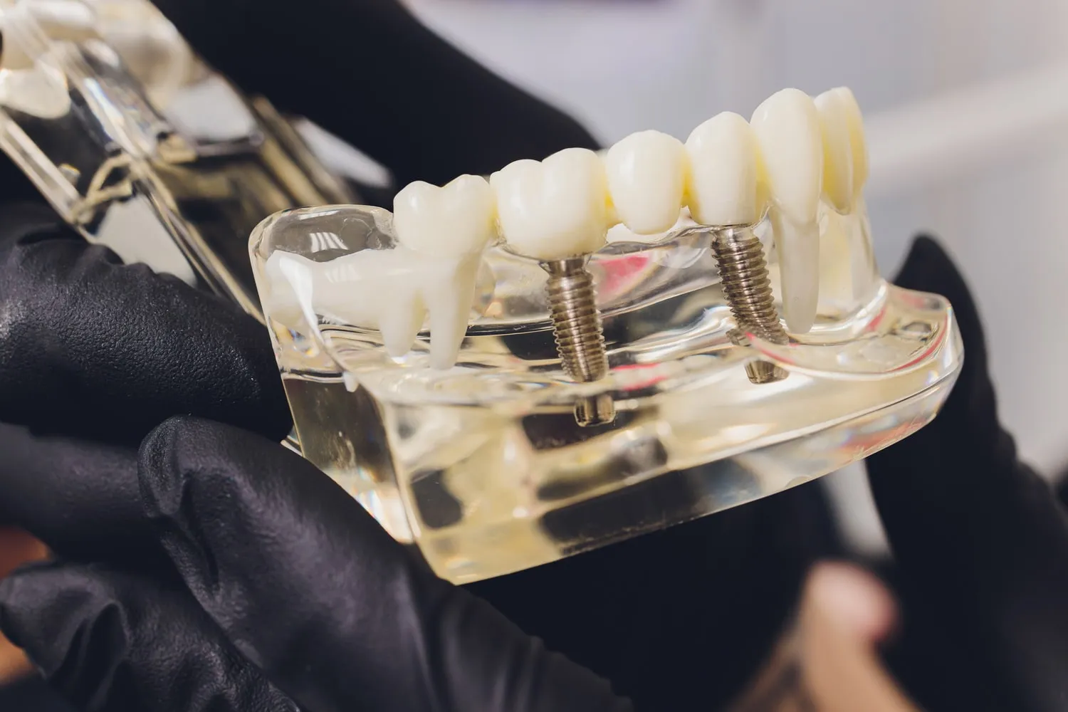 Modelo transparente de mandíbula con un puente dental sobre dos implantes de titanio, sostenido con guantes negros