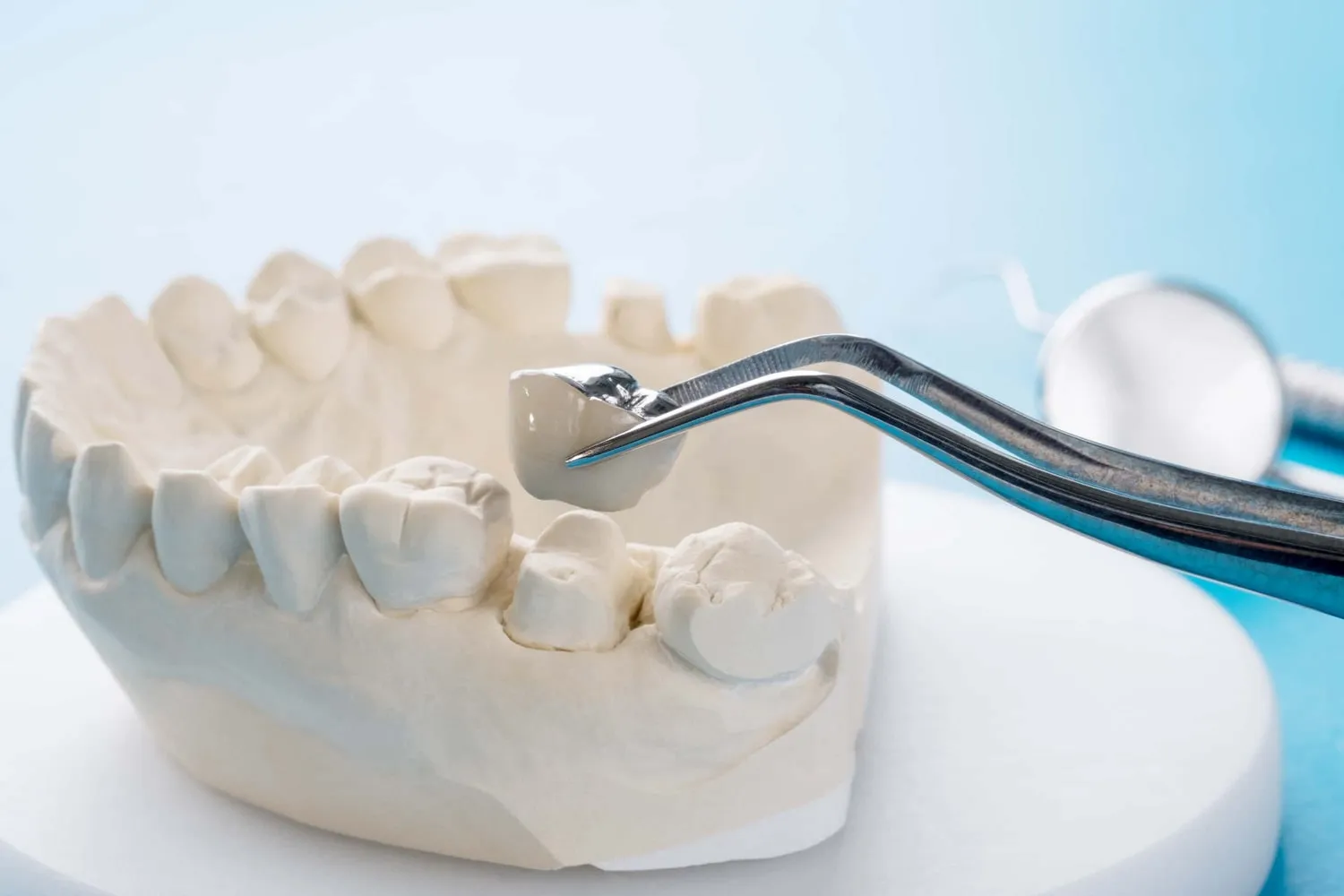 Pinzas colocan una corona dental sobre un modelo de yeso de la arcada inferior