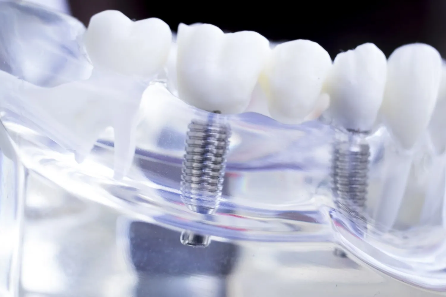 Modelo transparente de mandíbula con dos implantes roscados y coronas blancas