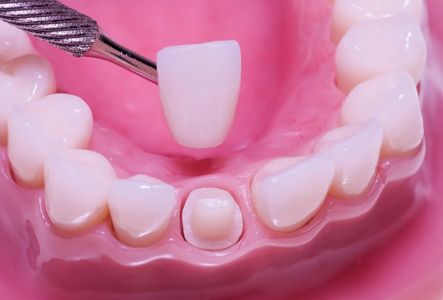 Pinza colocando una corona de aspecto natural sobre un diente tallado en una dentadura