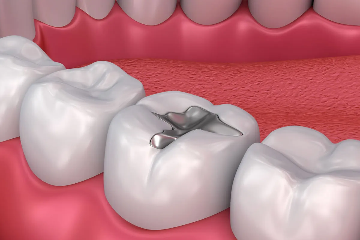 Ilustración 3D de una muela con un empaste metálico oscuro en la cara de masticación