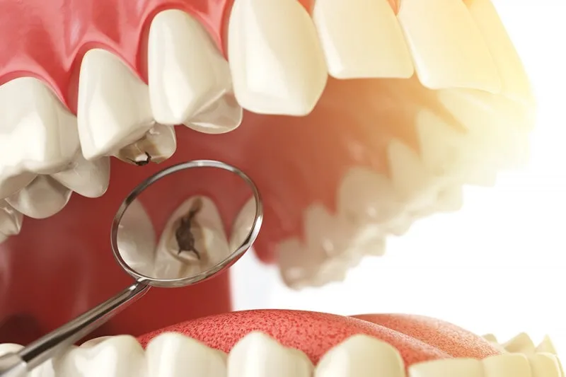 Espejo dental reflejando una muela con un empaste dañado, visto desde dentro de la boca