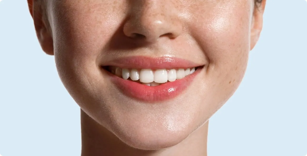 Primer plano de una sonrisa con los dientes blancos, después de un blanqueamiento dental (imagen ilustrativa)